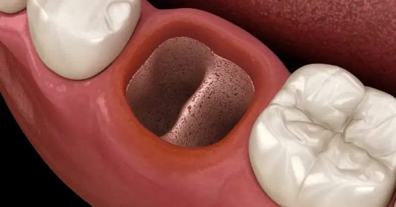 7 Effective Ways to Get Food Out of Wisdom Tooth Holes